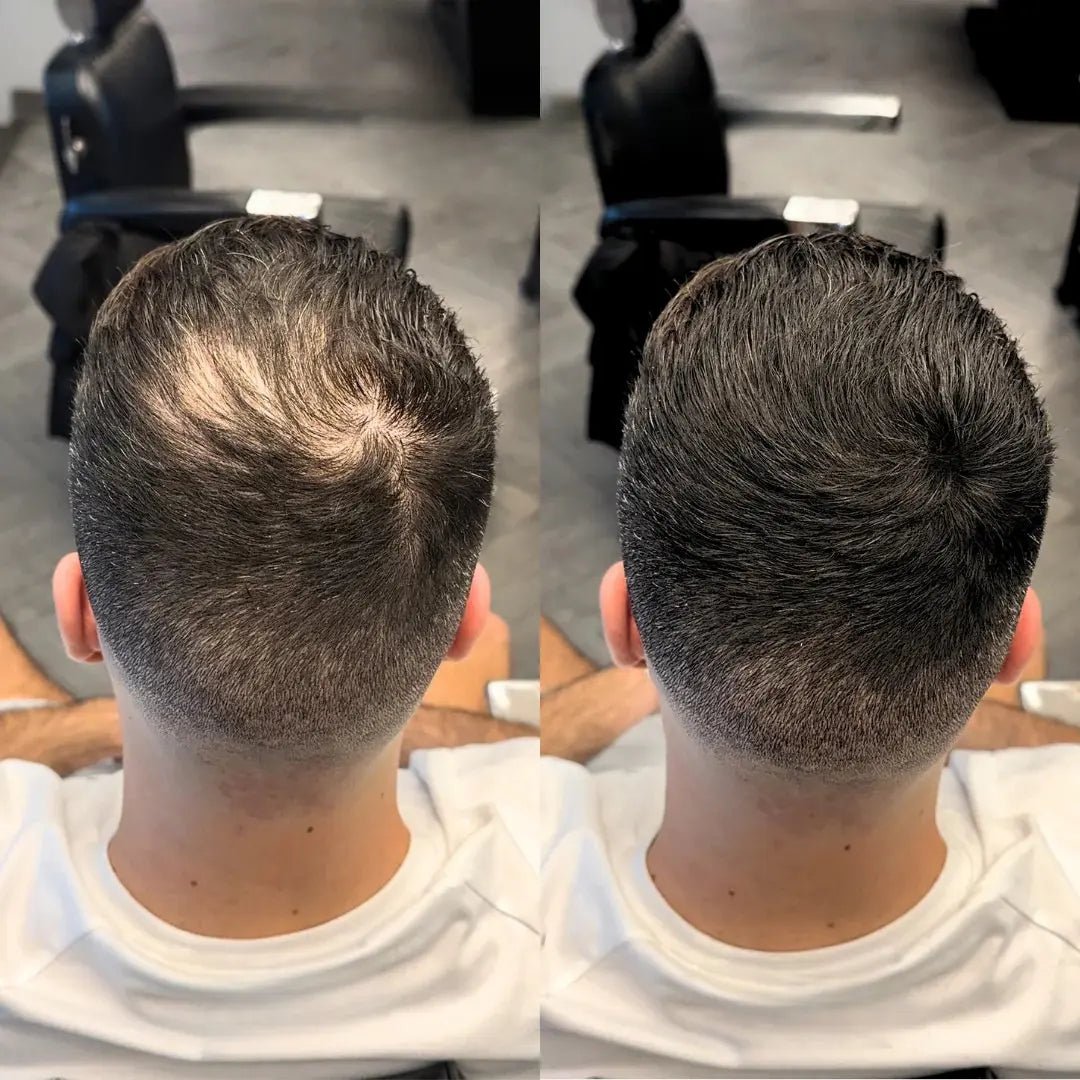 Apex Hair® – Professionell hårkamouflage