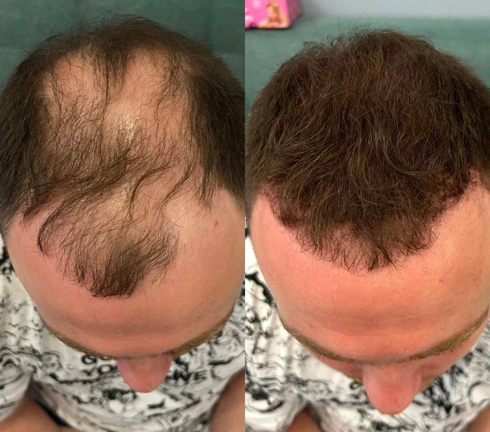 Apex Hair® – Professionell hårkamouflage